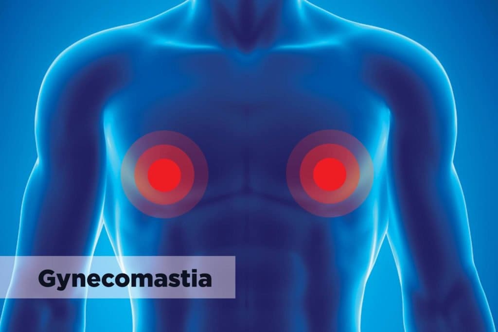 Gynecomastia