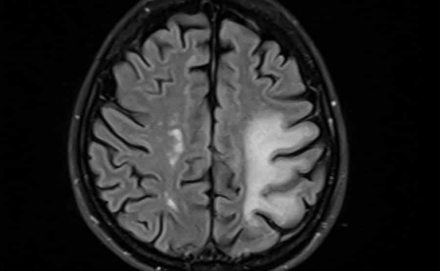 Brain MRI with progressive multifocal leukoencephalopathy (PML).