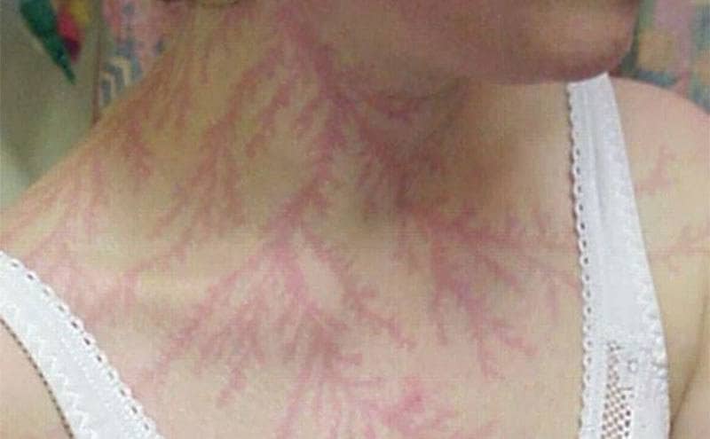 Lightning tracks on the chest of a woman struck by lightning.