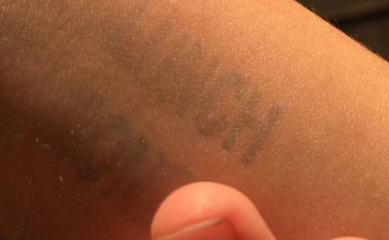 A photo of the mark on Cayden’s arm.