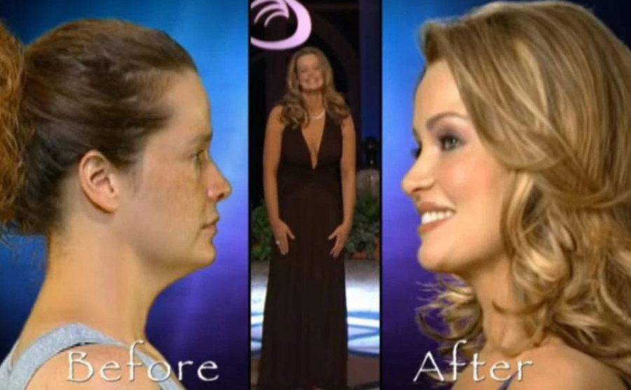 Before and after images of a contestant on The Swan.