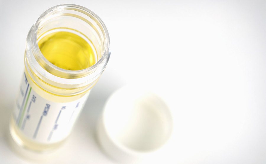 A photo of a urine sample